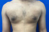 Gynecomastia case #9675