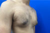 Gynecomastia case #9675