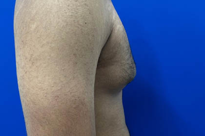 Gynecomastia case #9675