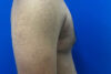 Gynecomastia case #9675