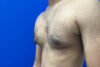 Gynecomastia case #9675