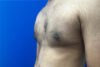 Gynecomastia case #9675