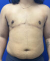 FTM with Nipple Grafts case #11254