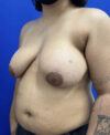 FTM with Nipple Grafts case #11254