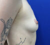 Breast Augmentation case #11277