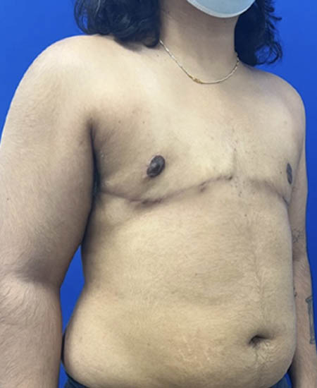 FTM with Nipple Grafts case #11254